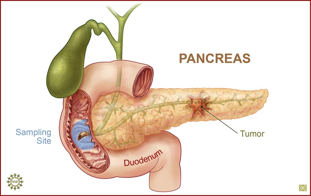Resultado de imagen para cancer de pancreas