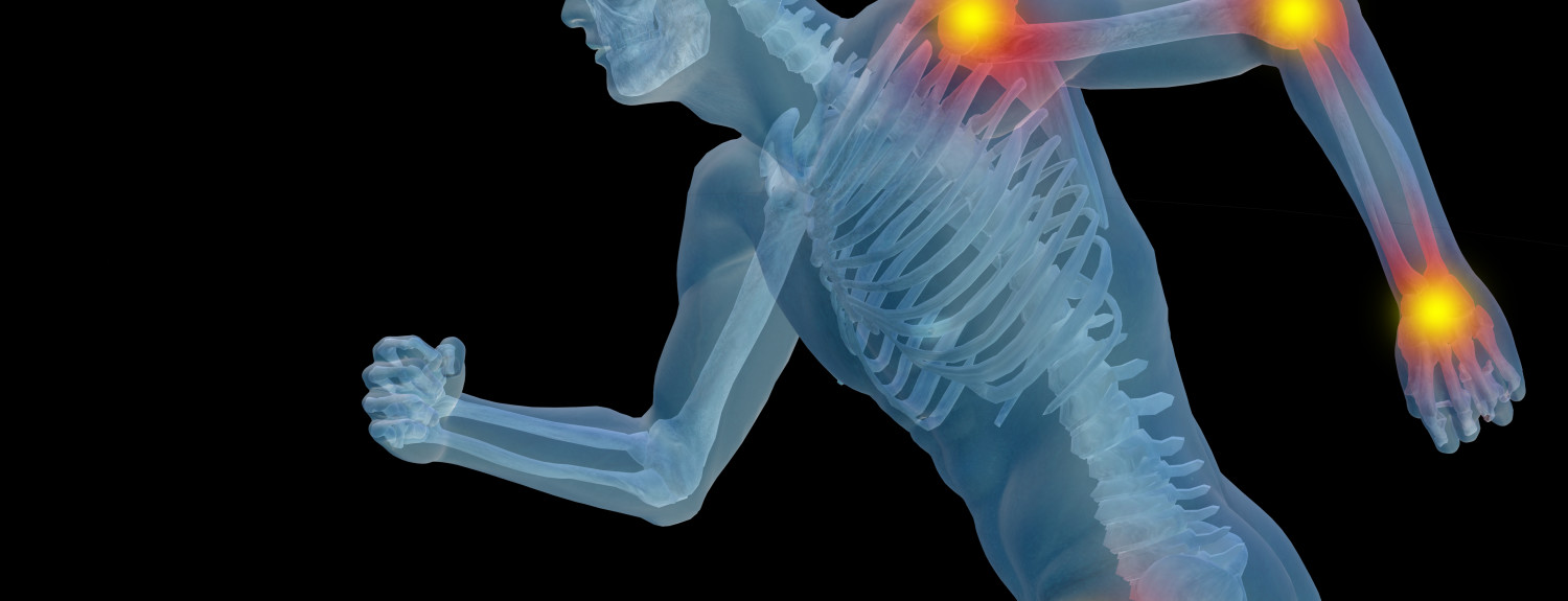Arthritis-2