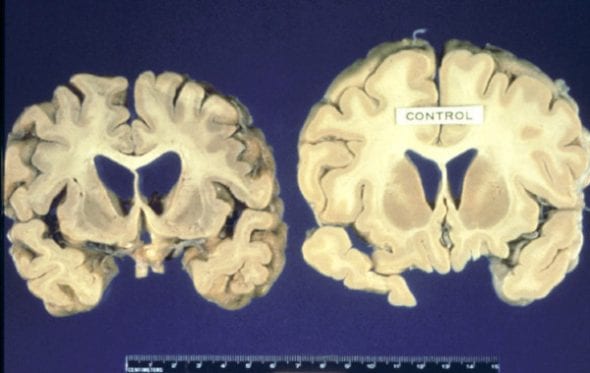 El cerebro de un individuo que murió de EET comparado con un cerebro normal (© duke.edu)