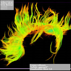 El cuerpo calloso, la región más grande de la sustancia blanca del cerebro, representada en imágenes ITD (© Andras Jakab)